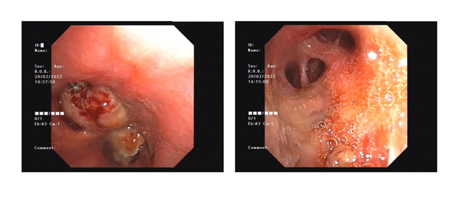 1646361140535977.jpg 支气管镜下消融术前后对比.jpg