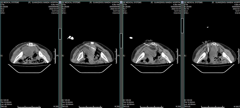 1646789216397141.jpg 术前术中CT对比02.jpg