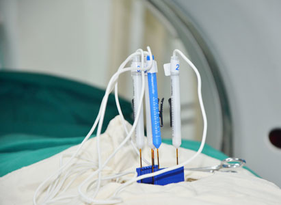 广州圣丹福医院,纳米刀,胰腺癌治疗