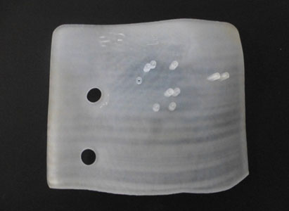 3D打印模板粒子植入术,粒子植入治疗,癌症治疗,圣丹福广州圣丹福肿瘤医院