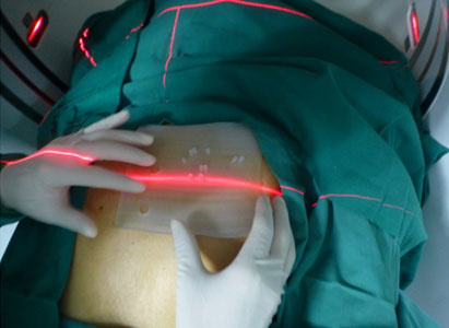 3D打印模板粒子植入术,粒子植入治疗,癌症治疗,圣丹福广州圣丹福肿瘤医院