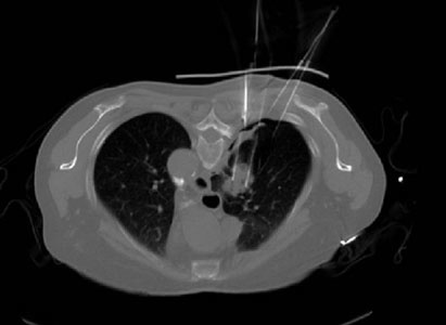 3D打印模板粒子植入术,粒子植入治疗,癌症治疗,圣丹福广州圣丹福肿瘤医院
